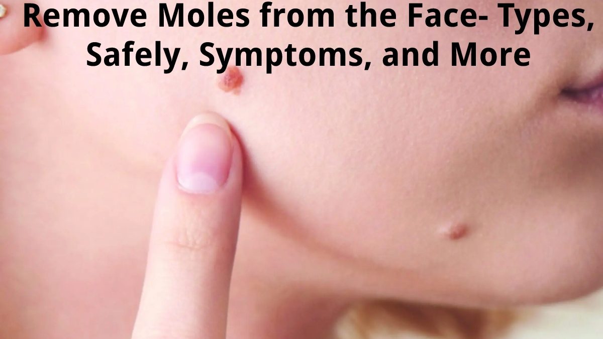 Remove Moles from the Face – Types, Safely, Symptoms, and More