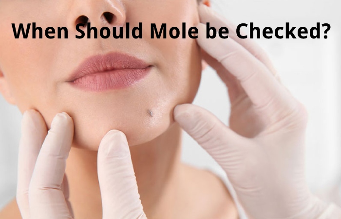 When Should Mole be Checked?