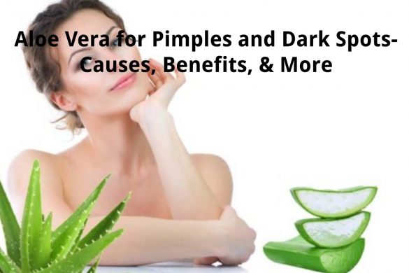 aloe vera for pimples and dark spots